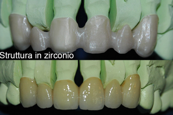 lavoro-in-zirc-ceram8AF18CE1-30B4-59B4-E8EB-E4D3657E699C.png